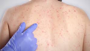 Brasil tem 570 novos casos de sarampo